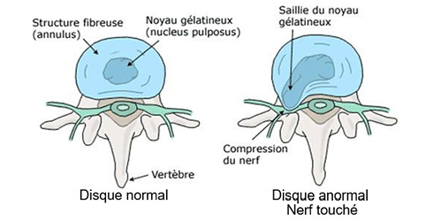 disque normal et disque anormal